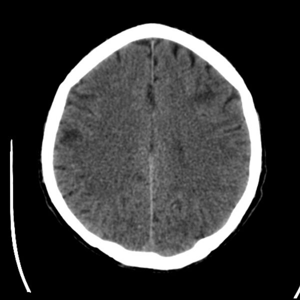File:Brain metastases from lung cancer (Radiopaedia 24480-24781 Axial non-contrast 33).jpg