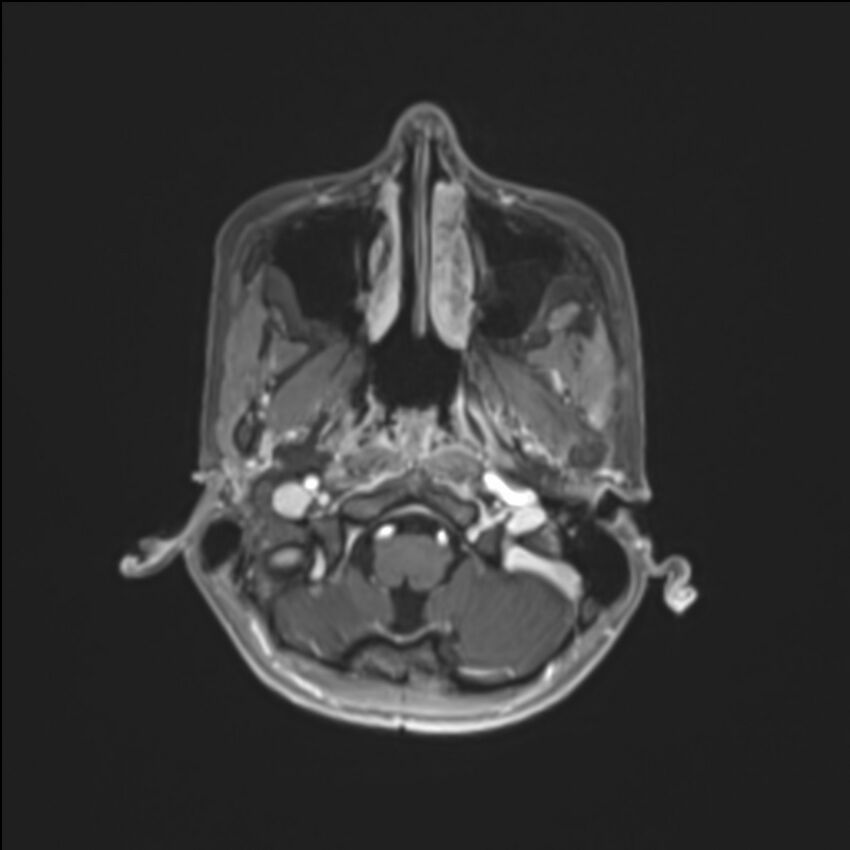 Brainstem glioma (Radiopaedia 70548-80674 Axial T1 C+ 25).jpg