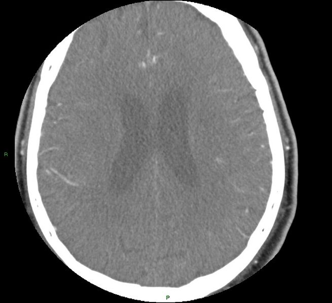 File:Brainstem hemorrhage (Radiopaedia 58794-66028 D 125).jpg