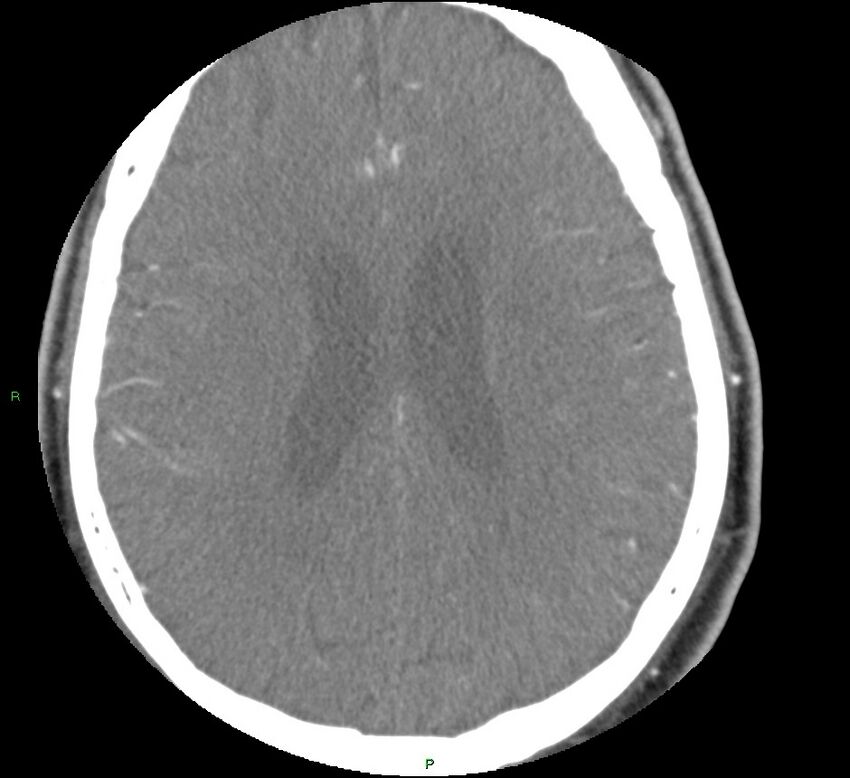 Brainstem hemorrhage (Radiopaedia 58794-66028 D 126).jpg