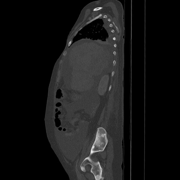 File:Breast cancer metastases - hepatic and skeletal (Radiopaedia 34201-35461 Sagittal bone window 29).jpg