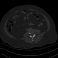 Breast carcinoma with pathological hip fracture (Radiopaedia 60314-67993 Axial bone window 1).jpg
