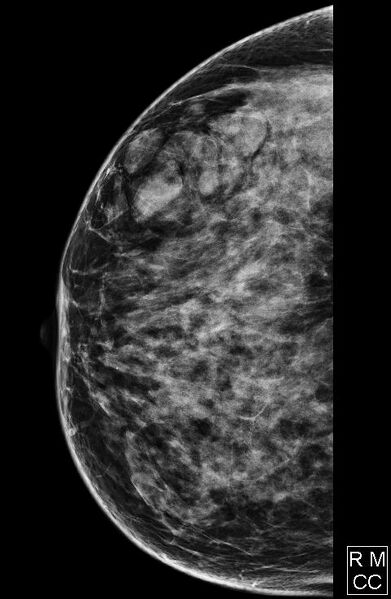 File:Breast within a breast sign - hamartoma (Radiopaedia 64005-72756 CC 1).JPG