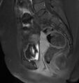 Broad ligament leiomyoma (Radiopaedia 81634-95516 G 14).jpg
