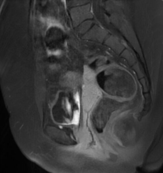 File:Broad ligament leiomyoma (Radiopaedia 81634-95516 G 14).jpg