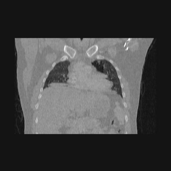 File:Bronchial atresia (Radiopaedia 60685-68439 Coronal lung window 49).jpg