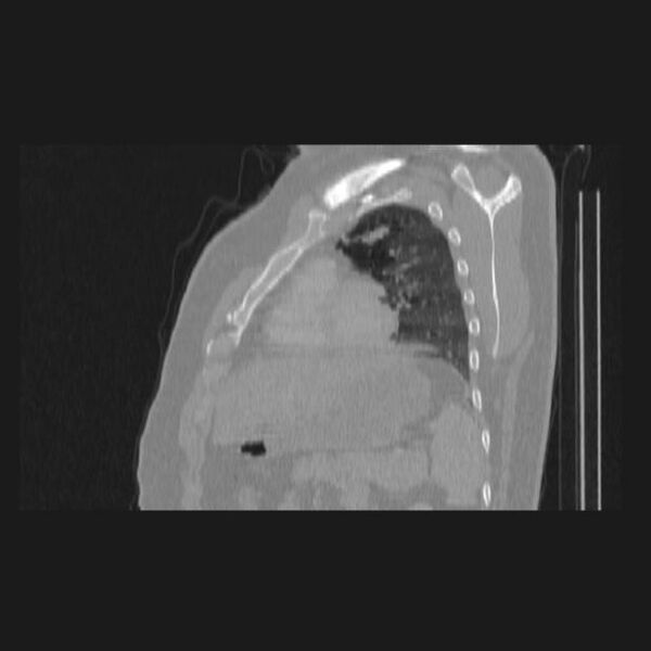 File:Bronchial atresia (Radiopaedia 60685-68439 Sagittal lung window 67).jpg