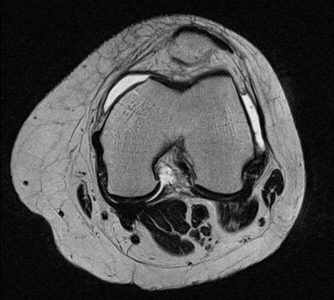 File:Bucket handle tear - medial meniscus (Radiopaedia 79028-91942 Axial T2 16).jpg