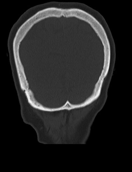 File:Burnt-out meningioma (Radiopaedia 51557-57337 Coronal bone window 47).jpg