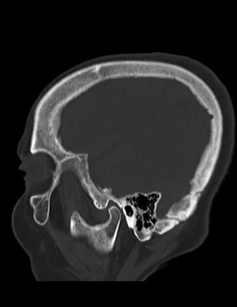 File:Burnt-out meningioma (Radiopaedia 51557-57337 Sagittal bone window 37).jpg
