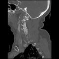 C1 anterior arch (plough) fracture - type 1 (Radiopaedia 76181-87720 Sagittal bone window 78).jpg