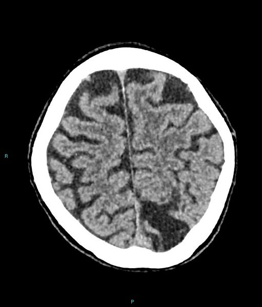File:Calcified cerebral emboli from left ventricular thrombus (Radiopaedia 84420-99758 Axial non-contrast 23).jpg