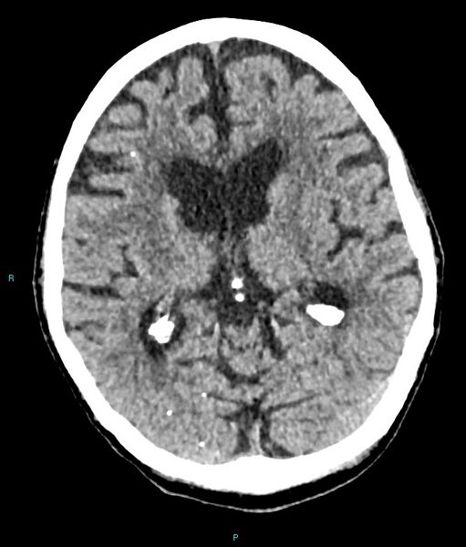 File:Calcified cerebral emboli from left ventricular thrombus (Radiopaedia 84420-99758 Axial non-contrast 48).jpg
