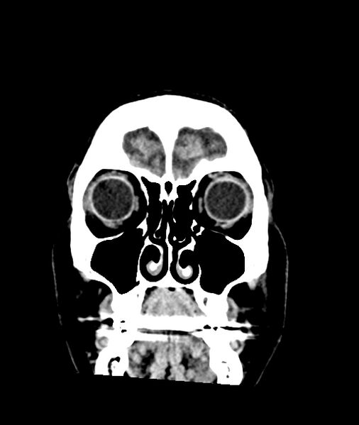 File:Calcified meningioma (Radiopaedia 74361-85243 Coronal non-contrast 3).jpg