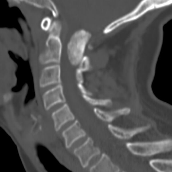 File:Calcified meningioma - cervical canal (Radiopaedia 70136-80171 Sagittal bone window 12).jpg