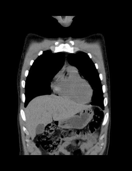 File:Calcifying pulmonary metastases (Radiopaedia 33359-34396 Coronal non-contrast 37).jpg