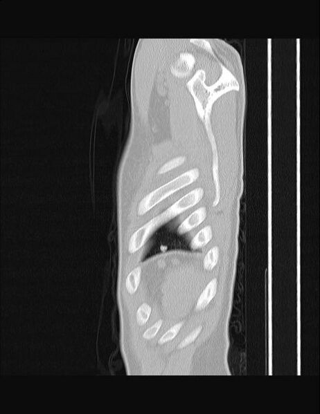 File:Calcifying pulmonary metastases (Radiopaedia 33359-34396 Sagittal lung window 3).jpg