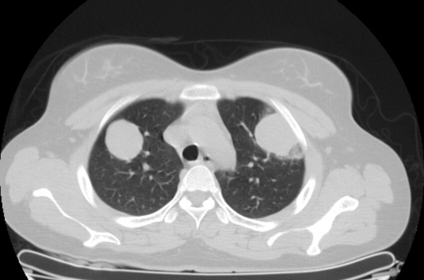 Cannonball metastases - uterine choriocarcinoma (Radiopaedia 70137-80173 Axial lung window 13).jpg