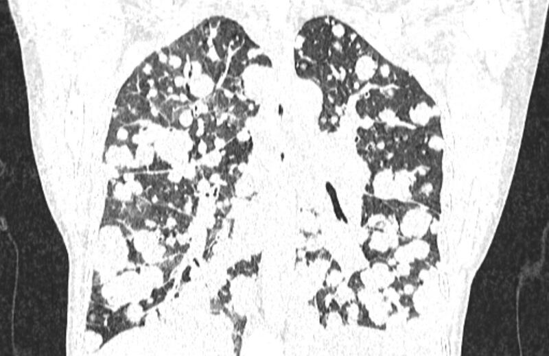 File:Cannonball metastases from breast cancer (Radiopaedia 91024-108569 Coronal lung window 90).jpg