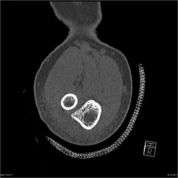 File:Capitellum fracture (Radiopaedia 23352-23426 Coronal bone window 52).jpg