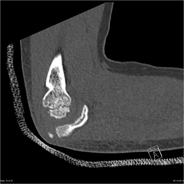 File:Capitellum fracture (Radiopaedia 23352-23426 Sagittal bone window 41).jpg