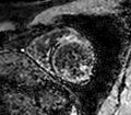 Cardiac sarcoidosis (Radiopaedia 39811-42243 LookLocker 1).jpg