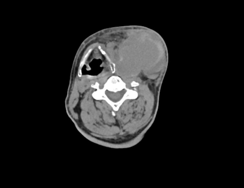 File:Carotid artery pseudoaneurysm (Radiopaedia 84030-99259 Axial non-contrast 25).jpg