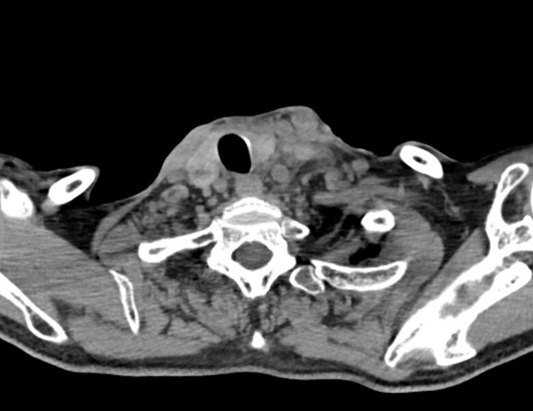File:Carotid artery pseudoaneurysm (Radiopaedia 84030-99259 Axial non-contrast 49).jpg