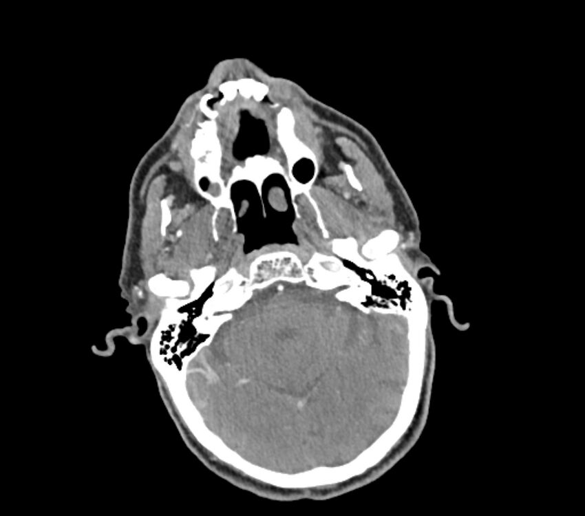 Carotid artery pseudoaneurysm (Radiopaedia 84030-99259 C 9).jpg