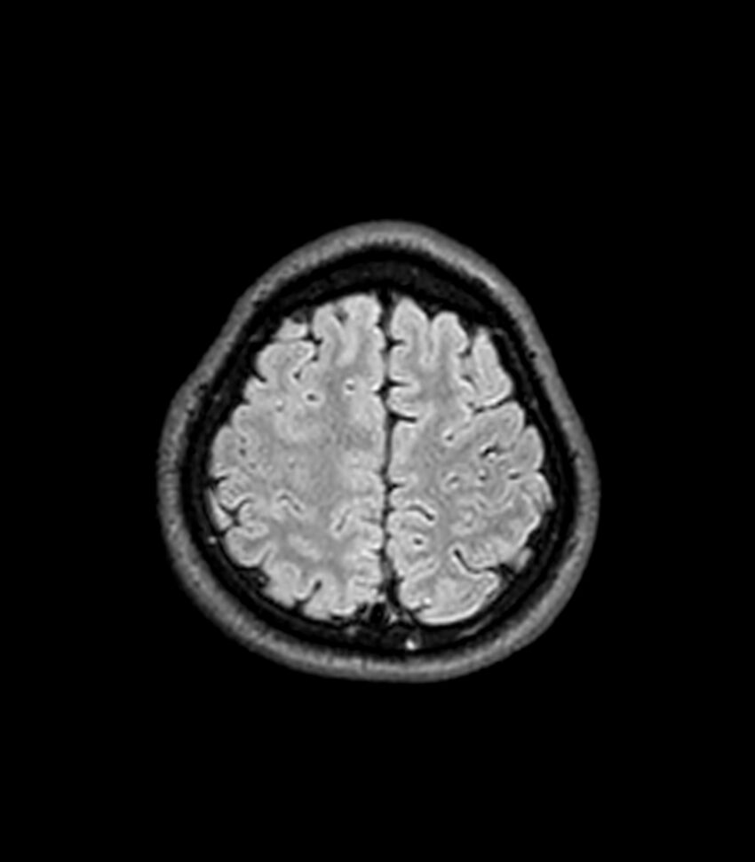 Central neurocytoma (Radiopaedia 79320-92380 Axial FLAIR 67).jpg