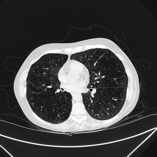 File:Centrilobular pulmonary emphysema (Radiopaedia 24495-24789 Axial lung window 54).jpg