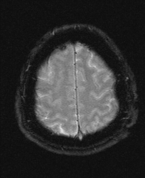 File:Cerebellopontine angle meningioma (Radiopaedia 24459-24764 Axial Gradient Echo 20).jpg