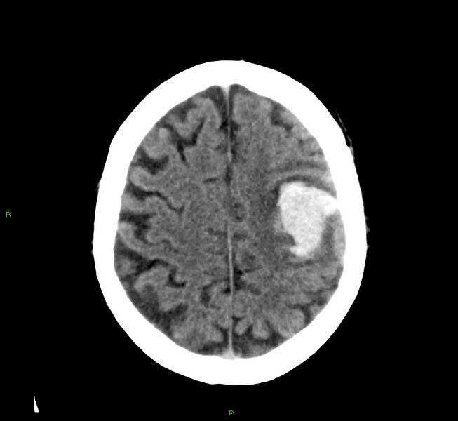 File:Cerebral amyloid angiopathy-associated lobar intracerebral hemorrhage (Radiopaedia 58376-65511 Axial non-contrast 17).jpg