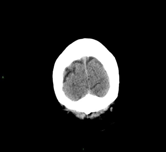 File:Cerebral amyloid angiopathy-associated lobar intracerebral hemorrhage (Radiopaedia 58376-65511 Coronal non-contrast 8).jpg