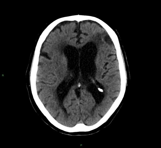 File:Cerebral amyloid angiopathy-associated lobar intracerebral hemorrhage (Radiopaedia 58376-65513 Axial non-contrast 25).jpg
