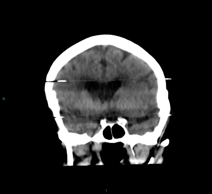 Cerebral amyloid angiopathy-associated lobar intracerebral hemorrhage (Radiopaedia 58377-65514 Coronal non-contrast 41).jpg