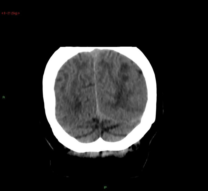 Cerebral amyloid angiopathy-associated lobar intracerebral hemorrhage (Radiopaedia 58378-65518 Coronal non-contrast 21).jpg