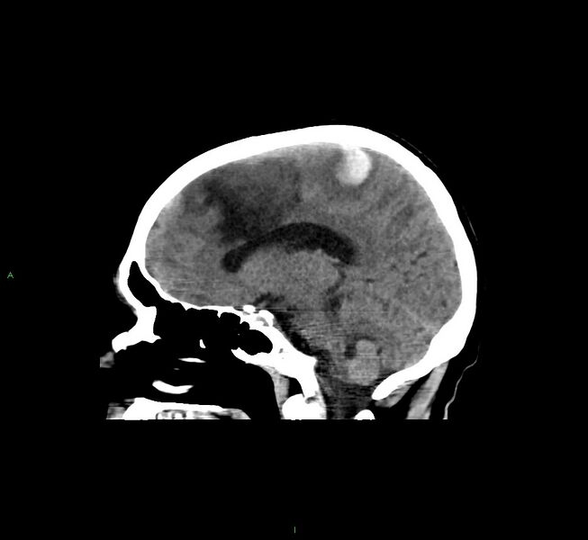File:Cerebral amyloid angiopathy-associated lobar intracerebral hemorrhage (Radiopaedia 58529-65681 B 28).jpg