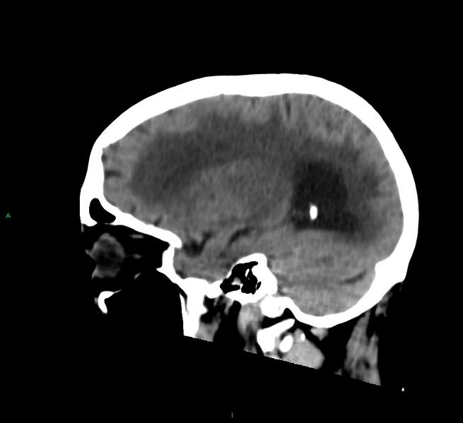 File:Cerebral amyloid angiopathy-associated lobar intracerebral hemorrhage (Radiopaedia 58530-65688 C 18).jpg