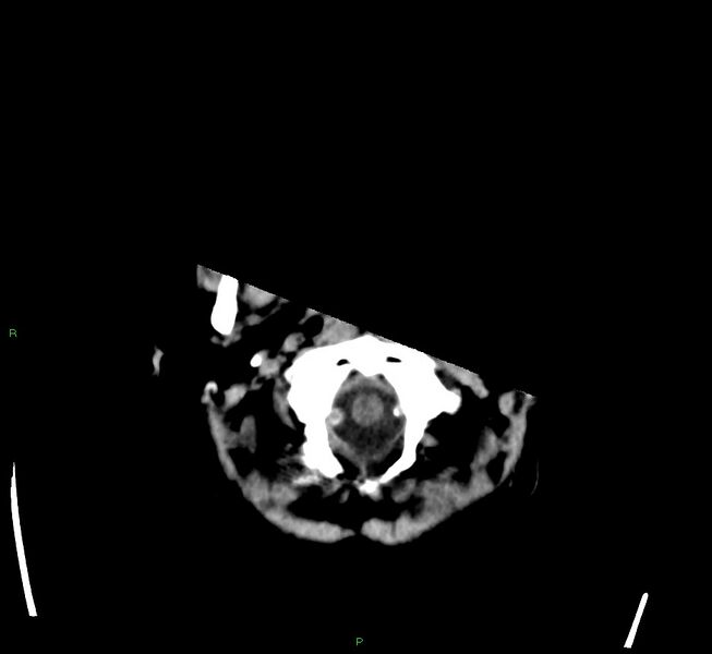 File:Cerebral amyloid angiopathy-associated lobar intracerebral hemorrhage (Radiopaedia 58563-65727 Axial non-contrast 50).jpg