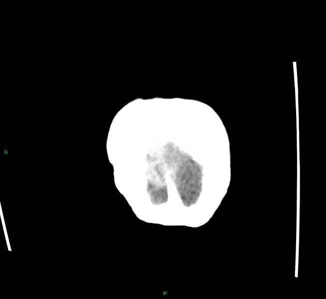 File:Cerebral amyloid angiopathy-associated lobar intracerebral hemorrhage (Radiopaedia 58563-65727 Coronal non-contrast 7).jpg