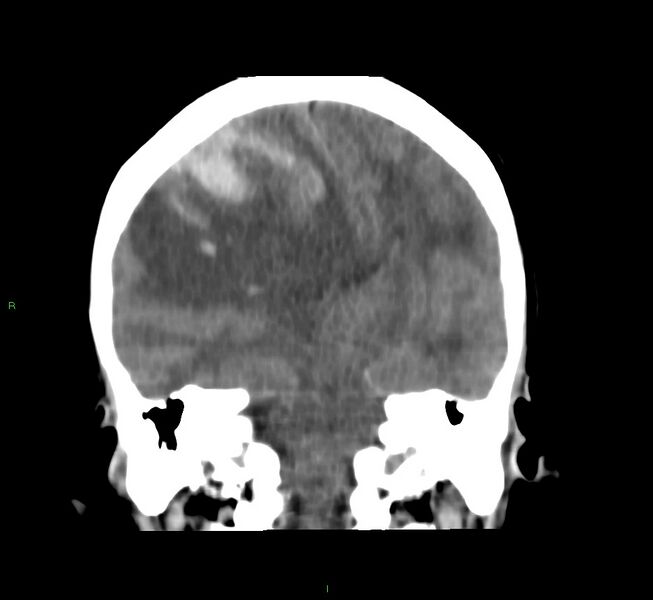 File:Cerebral amyloid angiopathy-associated lobar intracerebral hemorrhage (Radiopaedia 58751-65972 Coronal non-contrast 30).jpg