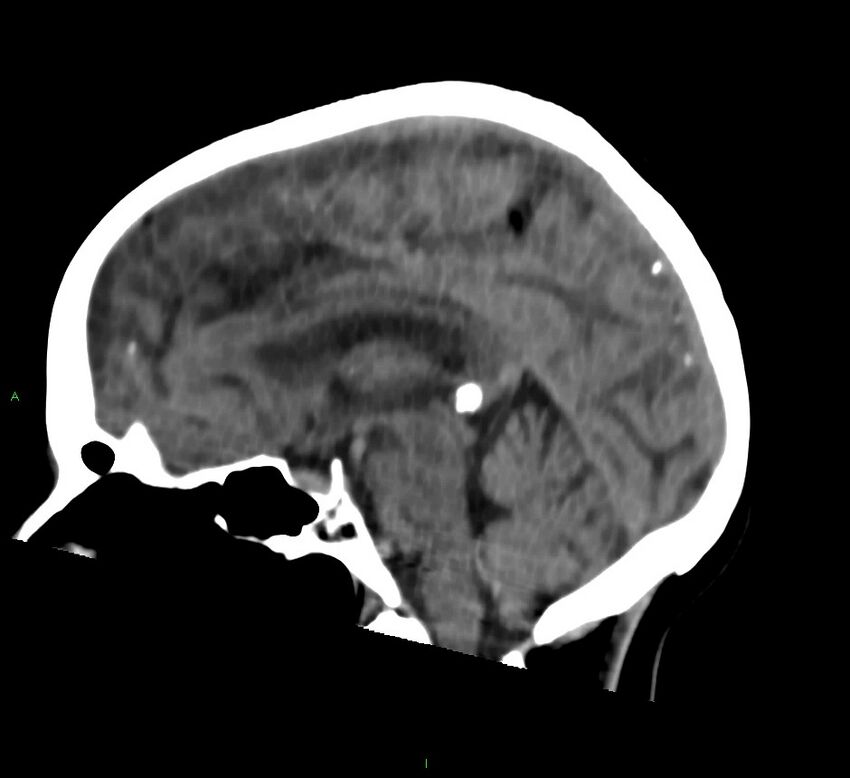 Cerebral amyloid angiopathy-associated lobar intracerebral hemorrhage (Radiopaedia 58757-65978 C 28).jpg
