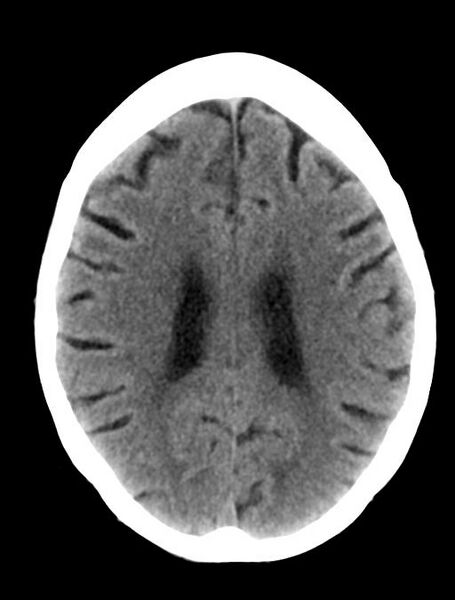 File:Cerebral aneurysm with rupture (Radiopaedia 29933-30457 Axial non-contrast 17).jpg
