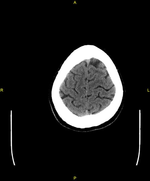 File:Cerebral autosomal dominant arteriopathy with subcortical infarcts and leukoencephalopathy (CADASIL) (Radiopaedia 86108-102051 Axial non-contrast 100).jpg