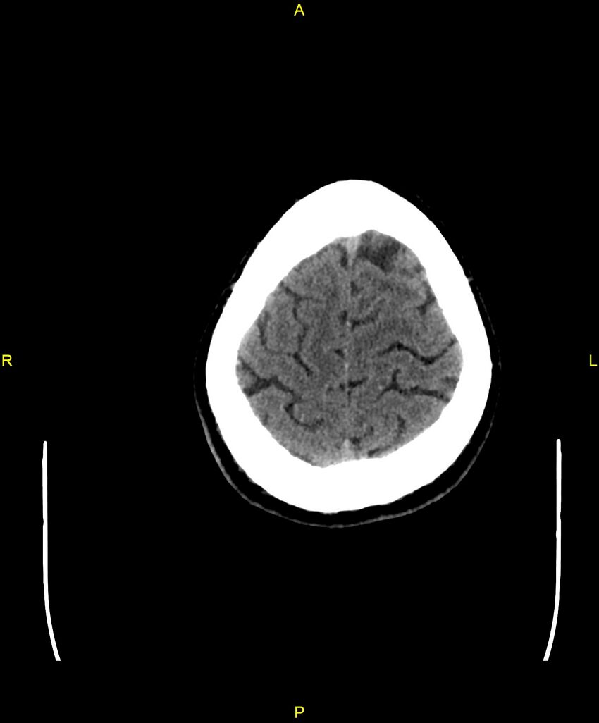 Cerebral autosomal dominant arteriopathy with subcortical infarcts and leukoencephalopathy (CADASIL) (Radiopaedia 86108-102051 Axial non-contrast 100).jpg