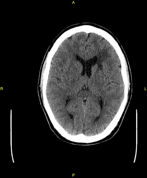 File:Cerebral autosomal dominant arteriopathy with subcortical infarcts and leukoencephalopathy (CADASIL) (Radiopaedia 86108-102051 Axial non-contrast 59).jpg