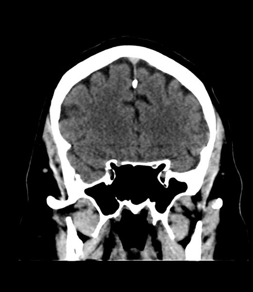 File:Cerebral dural venous sinus thrombosis (Radiopaedia 86514-102575 Coronal non-contrast 13).jpg