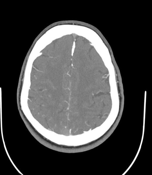 File:Cerebral dural venous sinus thrombosis (Radiopaedia 86514-102576 A 74).jpg