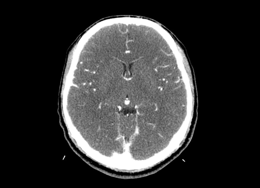 Cerebral edema (Radiopaedia 82519-96661 B 31).jpg